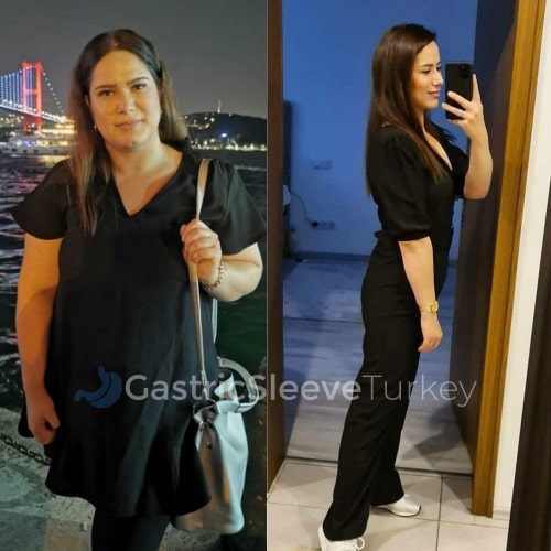 Weight Loss Surgery: Gastric Balloon Sümeyye E. Review